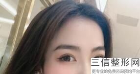 双眼皮修复必须要半年以后吗，双眼皮手术一个月后可以修复吗