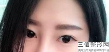 双眼皮修复宽改窄的方案，双眼皮宽变窄修复怎么修复
