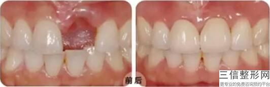 唐山哪里整牙比较好，唐山哪个医院种牙好