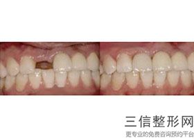 糖尿病能否种植牙，糖尿病可以种植牙齿吗