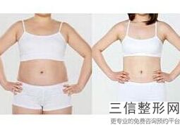 臀部可以抽脂吗，抽脂丰臀手术后的注意事项