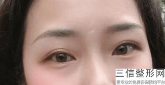 外切眼袋能去除皱纹吗，什么是外切去眼袋