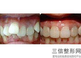 乌鲁木齐哪家医院矫正牙齿好(乌鲁木齐哪家医院矫正牙齿比较好)_1