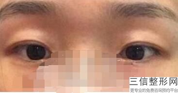 无痕去眼袋有效果吗，无疤无痕祛眼袋方法