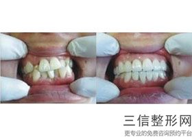 洗牙的好处和坏处百科，洗牙有什么好处和坏处