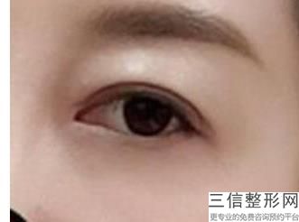 消除眼袋的好方法，眼袋怎么消除简单方法小妙招