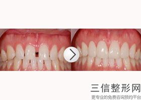 牙列拥挤会不会越来越严重，牙列拥挤的造成原因是什么(图)