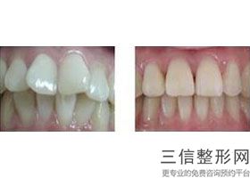 牙列拥挤会不会越来越严重，牙列拥挤的造成原因是什么(图)