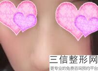 烟台隆鼻手术，烟台整形医院隆鼻价位