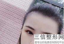 眼部祛眼袋,祛眼袋的比较有效方法