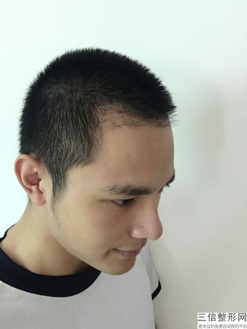 在北京植发多少钱，北京头发移植手术大概需要多少钱