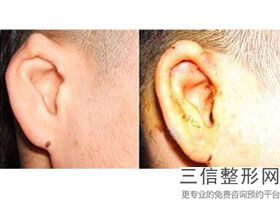 招风耳整形过程视频，招风耳整形医院