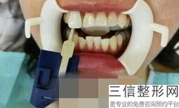 郑州拔智齿哪个医院好，郑州拔牙哪家医院好