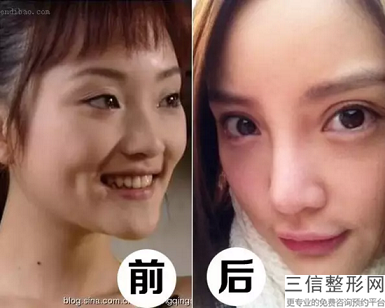 郑州人民医院瘦脸针价格，在郑州打瘦脸针多少钱