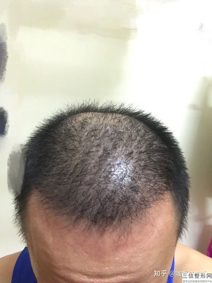 郑州良好的植发医院排名，郑州植发三甲医院