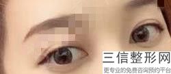 肿眼皮适合做双眼皮吗,肿泡眼适合做什么形状的双眼皮
