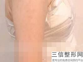 自体隆胸的弊端,隆胸的优缺点