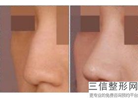 自体软骨隆鼻对比，自体软骨隆鼻的害处