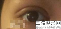 做过双眼皮手术后注意事项，双眼皮术后注意事项有哪些-为什么-