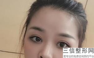 做双眼皮整形术，手术做双眼皮整形