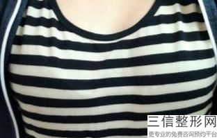 15分钟隆胸术怎么样，15分钟极速隆胸