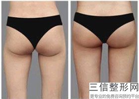 18分钟极速丰胸效果好吗，极速丰胸后悔