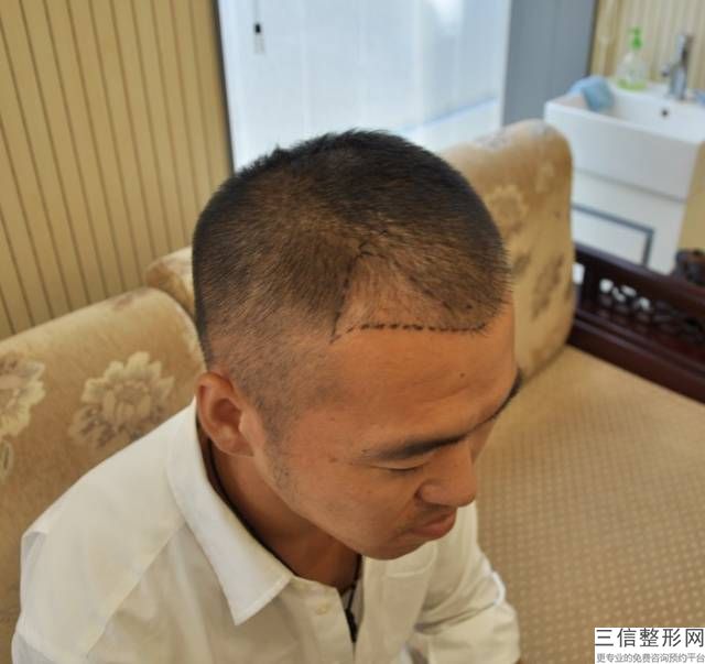 ARTAS植发机器人，植发机器人哪个医院有
