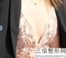 ES伊思雅胸假体型号，法国伊思雅假体分几款