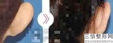 medpor支架一次成型耳再造术，medpor支架造耳是不是终身受用