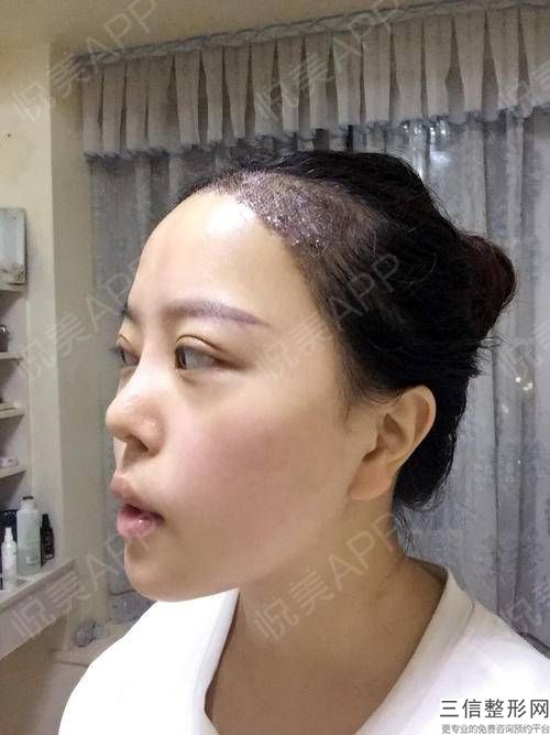 o型脱发适合植发吗,三级脱发植发要一万