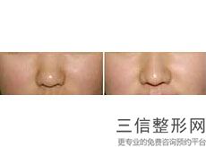 peek材料填充鼻基底，3d打印鼻基底填充效果怎么样