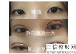 爱德丽格王香平做双眼皮怎么样，大连爱德丽格双眼皮价格