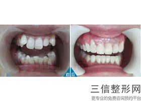 爱康健种牙价目表,深圳市口腔医院种植牙价格