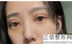 安徽双眼皮医院排名榜里有做眼修复比较好的医生吗,安徽双眼皮医院排名榜里有做眼修复比较好的医院吗