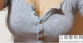 安庆隆胸哪家医院好点，安庆隆胸哪家医院好些