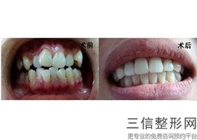 安阳种植3颗牙要多少钱一颗，安阳种植3颗牙要多少钱呢