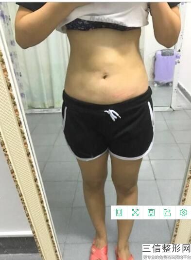 奥美定隆胸取出费用多少，成都假体丰胸多少钱