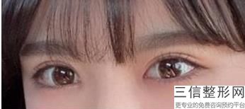 白永辉修复双眼皮怎么样啊，白永辉双眼皮修复贴吧