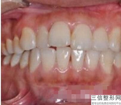 百色矫正牙齿大概多少钱啊，百色矫正牙齿大概多少钱一颗