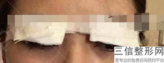 包头叶子整形双眼皮，包头哪个双眼皮做的好