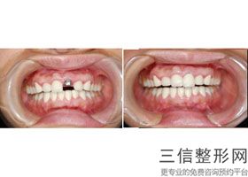 保定种植牙哪个医院良好,保定口腔医院种植牙怎么样