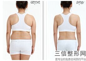 宝鸡抽脂医院排名，西安大腿抽脂哪里好