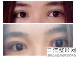 北京不开刀去眼袋哪家良好，北京 祛眼袋