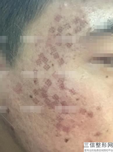 北京加减美拉皮手术价目表，拉皮价格加减美怎么在线咨询呢