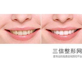 北京口腔医院烤瓷牙费用，北京医院烤瓷牙价格