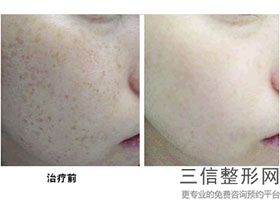 北京拉皮手术专家排名，国内拉皮手术哪家医院好