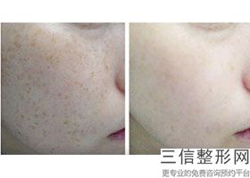 北京拉皮良好的医院，北京拉皮手术医院排名