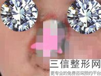 北京丽眼去眼袋怎么样,北京丽都吴玉家做鼻子