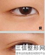 北京双眼皮修复医生排行榜,北京哪家医院修复双眼皮良好