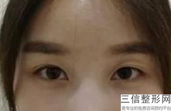 北京双眼皮修复医生排行榜，北京医院双眼皮修复谁做得好